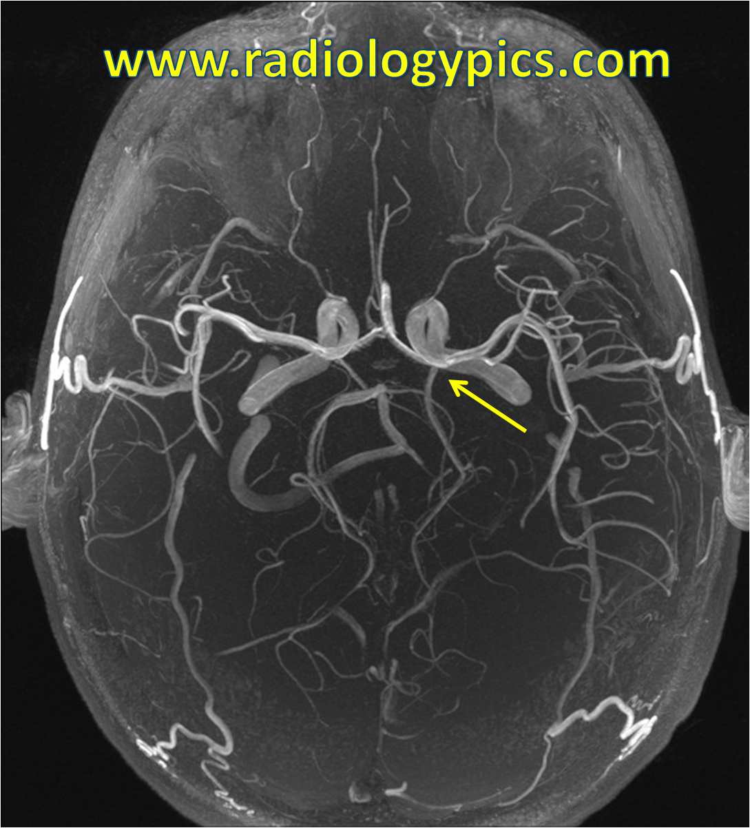 Brain artery model simulates cerebral function